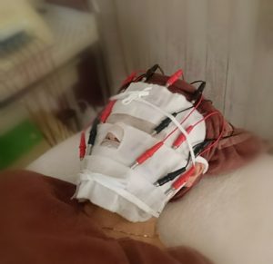 バイオニックセルサー施術